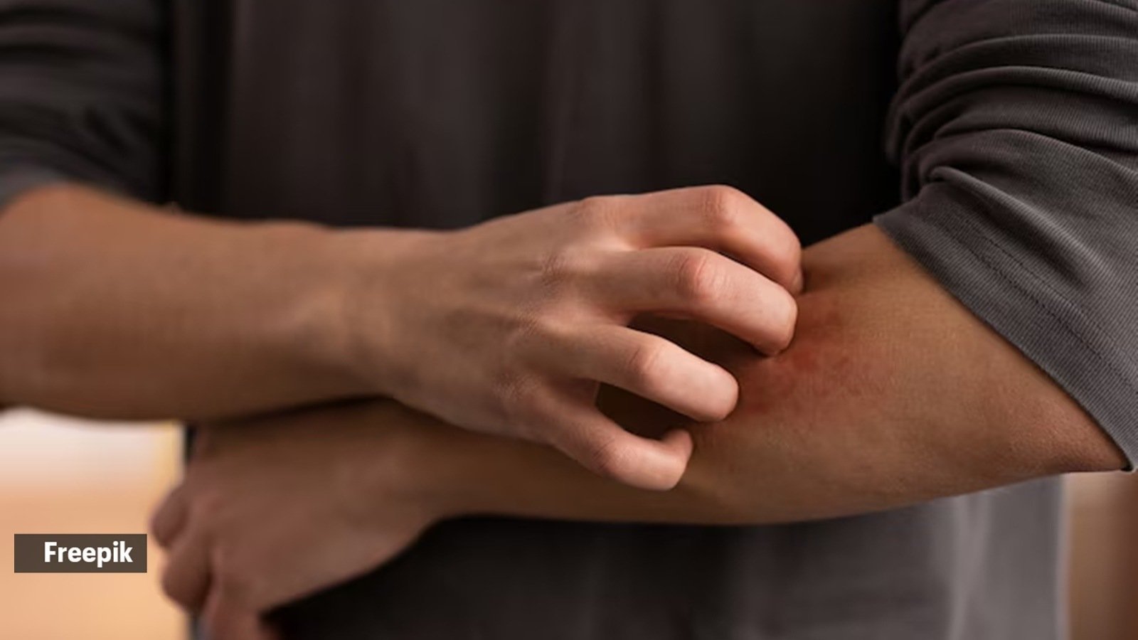 bee sting